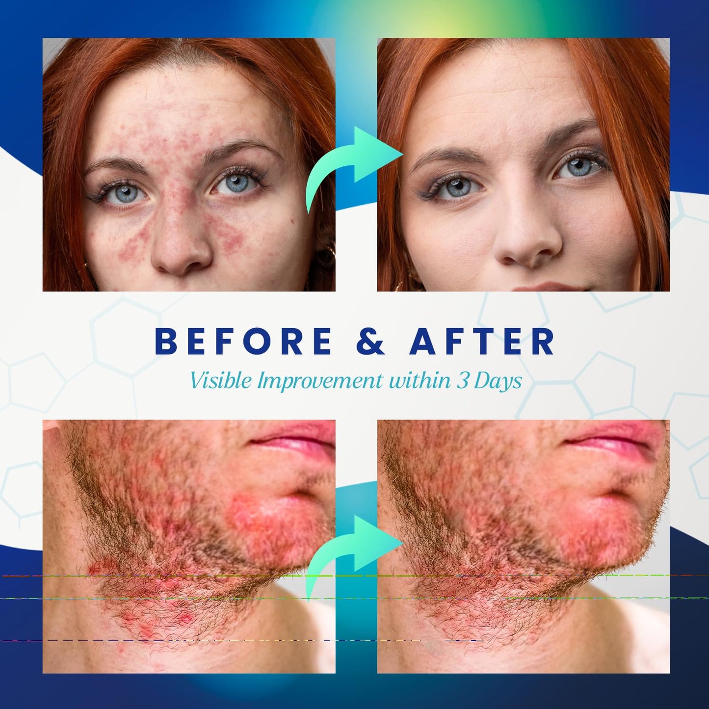 PureSkin Seborrheic Dermatitis & Psoriasis Cream – Steroid-Free Herbal Antifungal (3.4 oz)