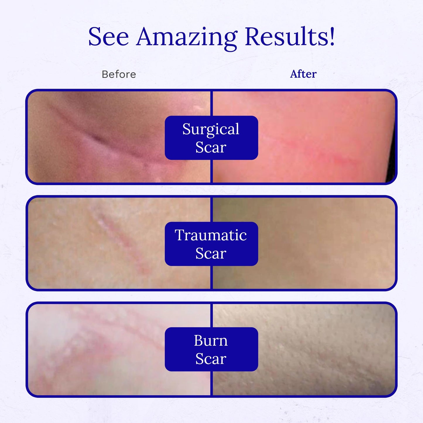 Rejuvaskin RejuvaSil Silicone Scar Gel – Scar Treatment for Surgical Scars, Burns & Acne (30ml)