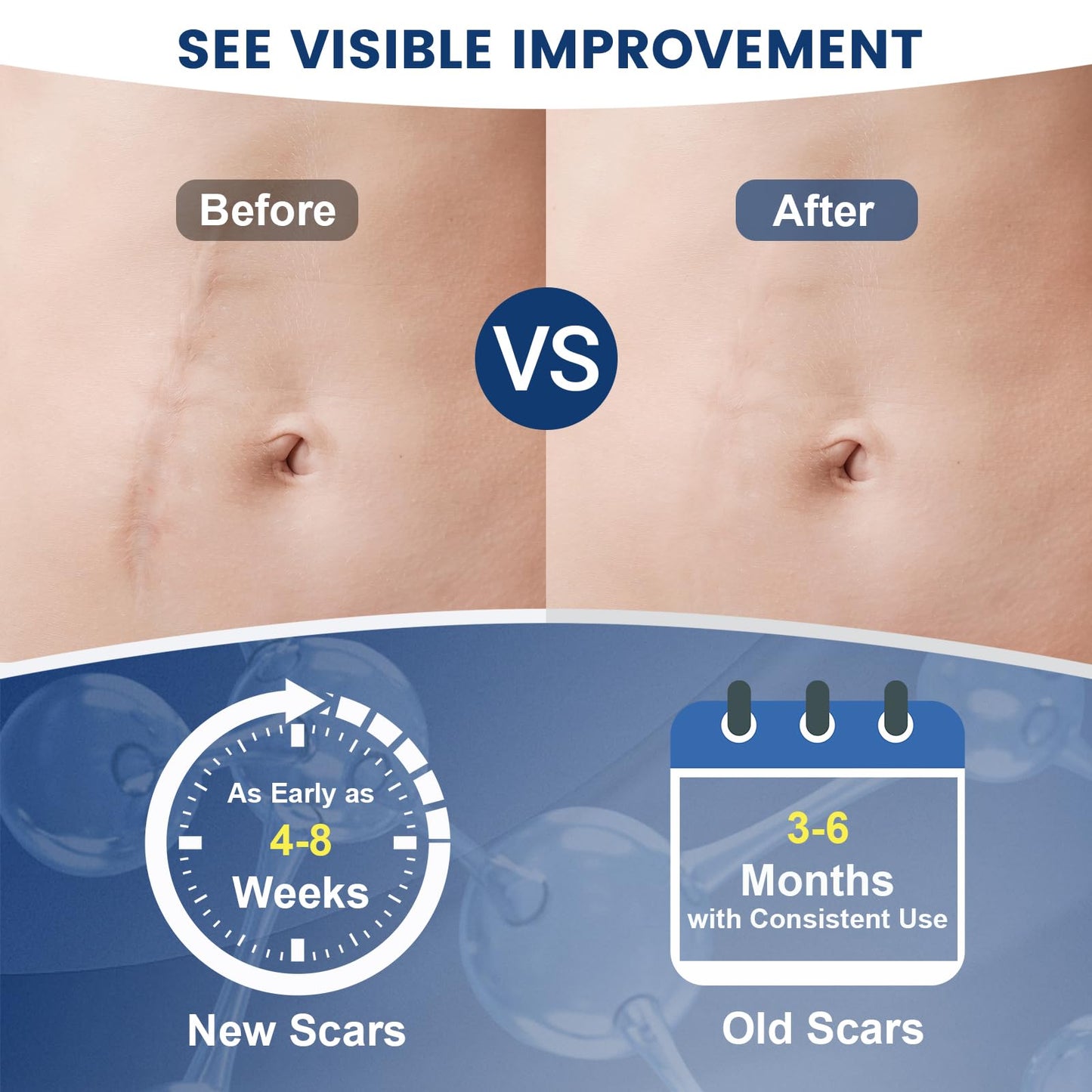 Rvlaim 100% Silicone Scar Gel | Advanced Scar Cream for Surgical, Burn, Acne Scars | 1.7 oz / 50 ml