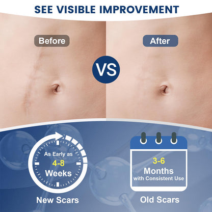 Rvlaim 100% Silicone Scar Gel | Advanced Scar Cream for Surgical, Burn, Acne Scars | 1.7 oz / 50 ml