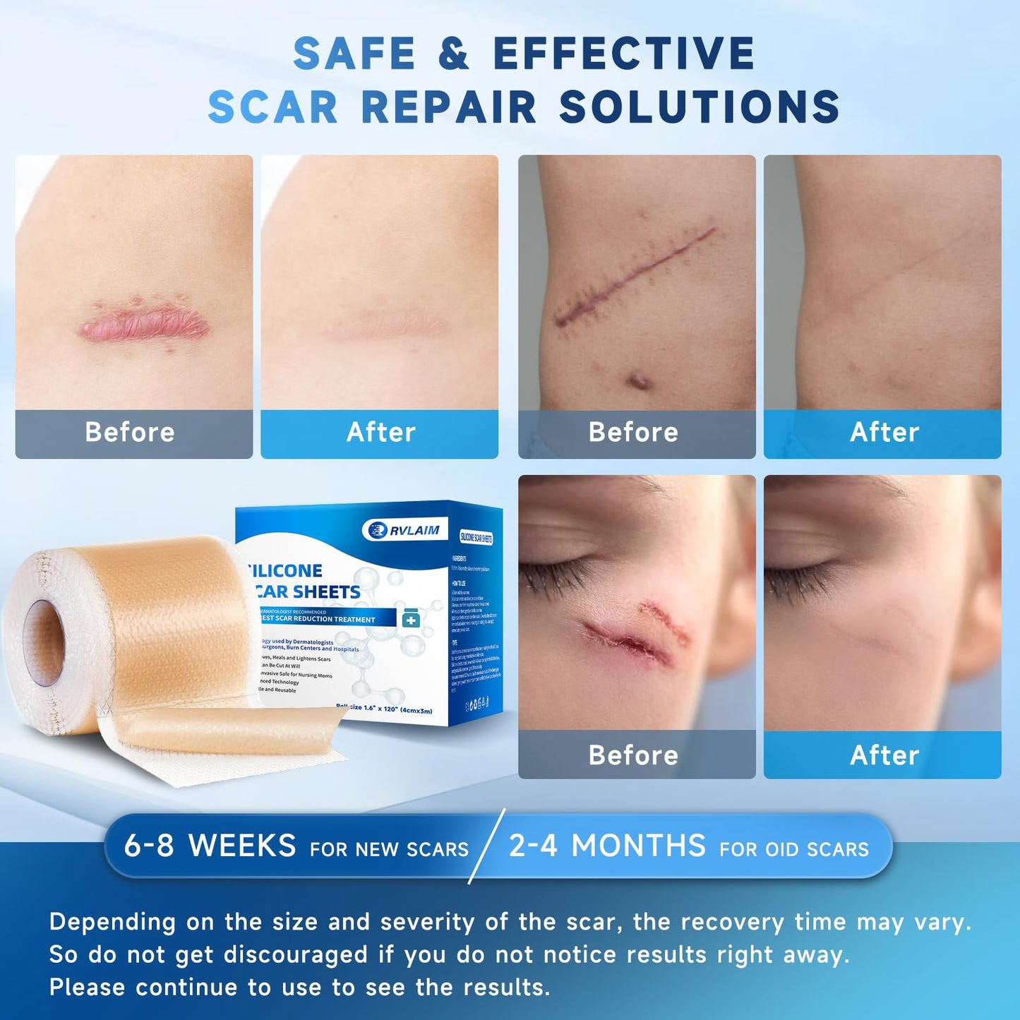 Rvlaim Silicone Scar Sheets & Tape – 3M Roll (1.6” x 120”), Surgical Scar & Stretch Mark Care