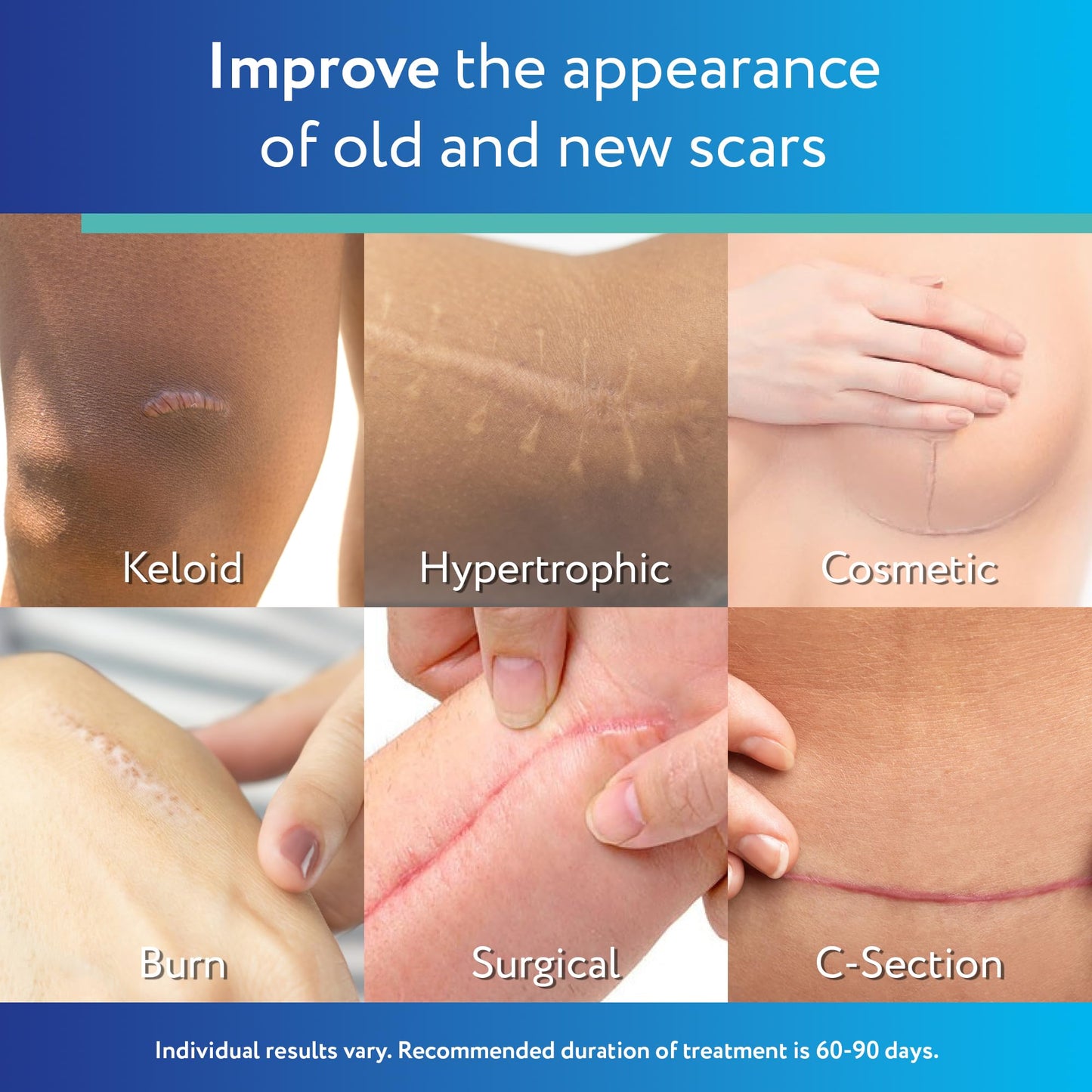 ScarAway Advanced Clear Silicone Scar Sheets (10 Count) – Medical-Grade Silicone Strips for Surgical, Burn, and Hypertrophic Scars