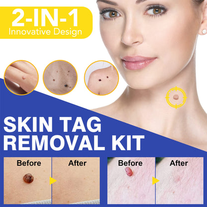SHISUIZHE Skin Tag Remover – FDA-Cleared At-Home Skin Tag Removal Kit