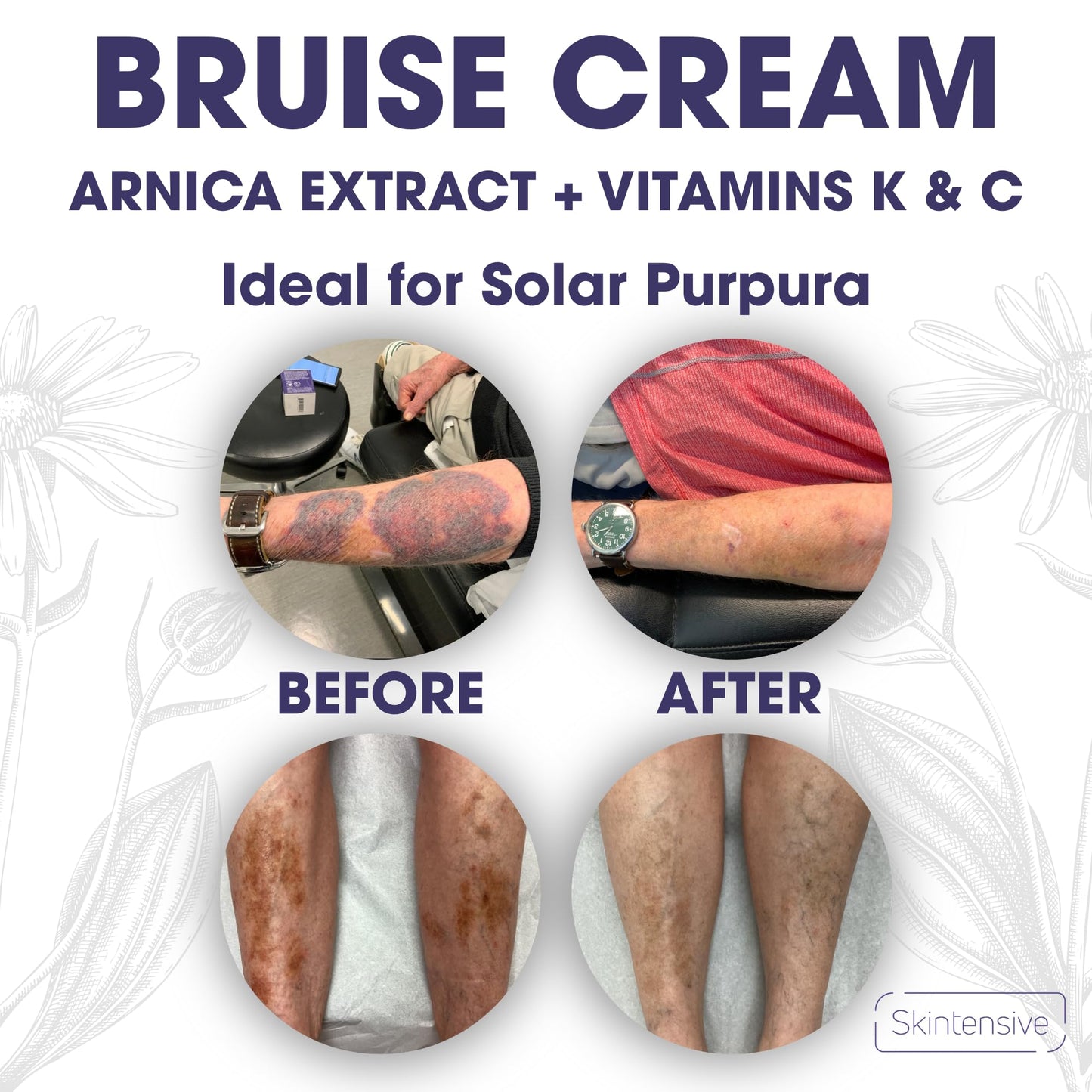 SKINTENSIVE Arnica Bruise Cream for Thin Skin – Moisturizing with Vitamins K, C & E (4 oz)