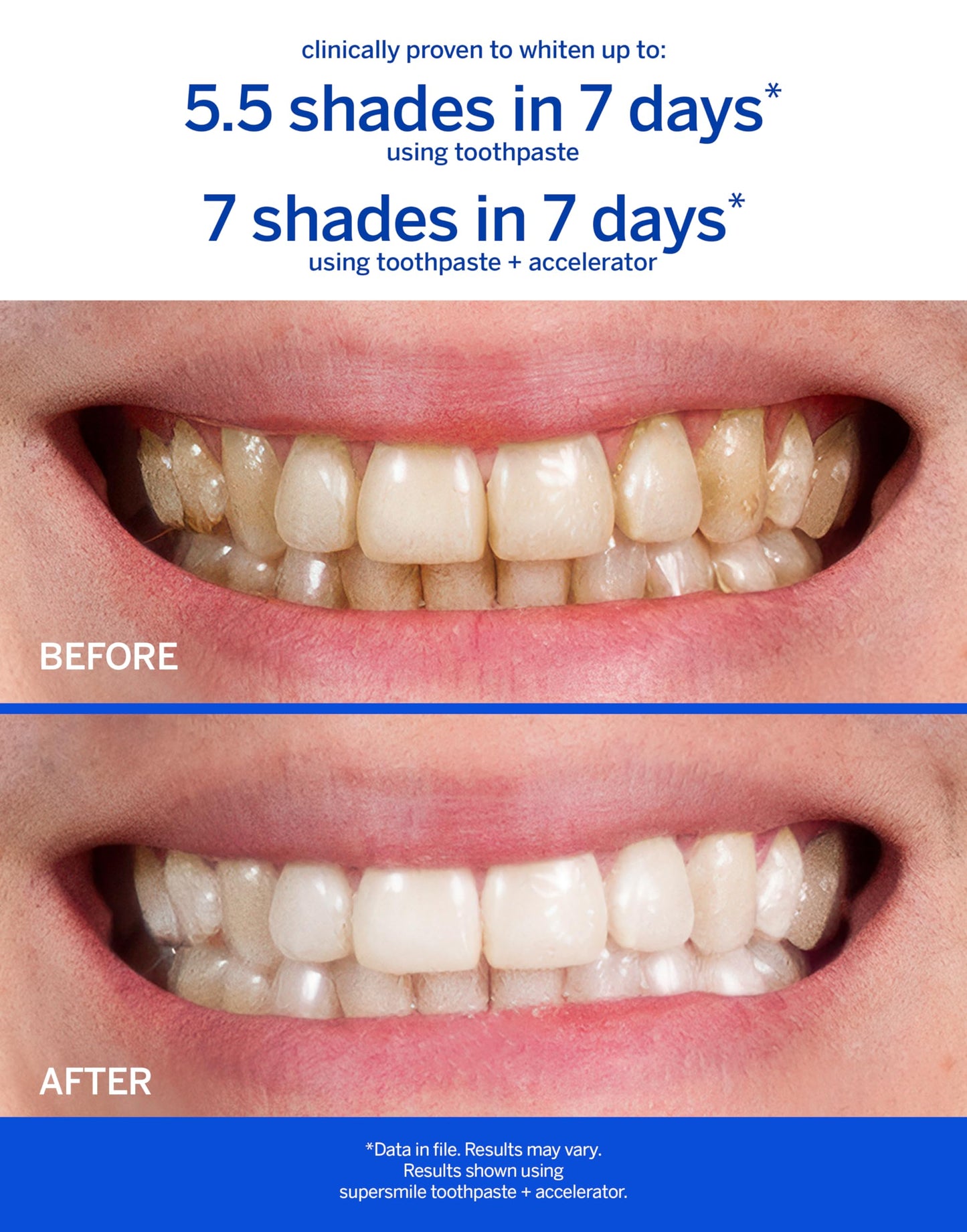 Supersmile Teeth Whitening System - Whitening Toothpaste & Accelerator | Up to 7 Shades