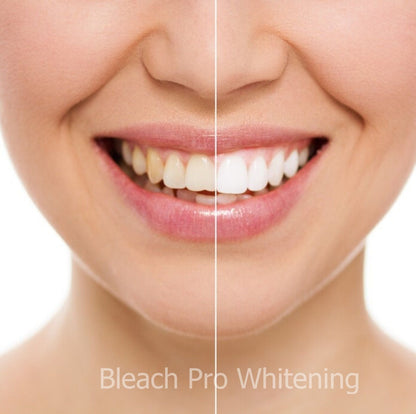 Teeth Whitening Gel Syringe 10ml - 44% Carbamide Peroxide - 4 Pack