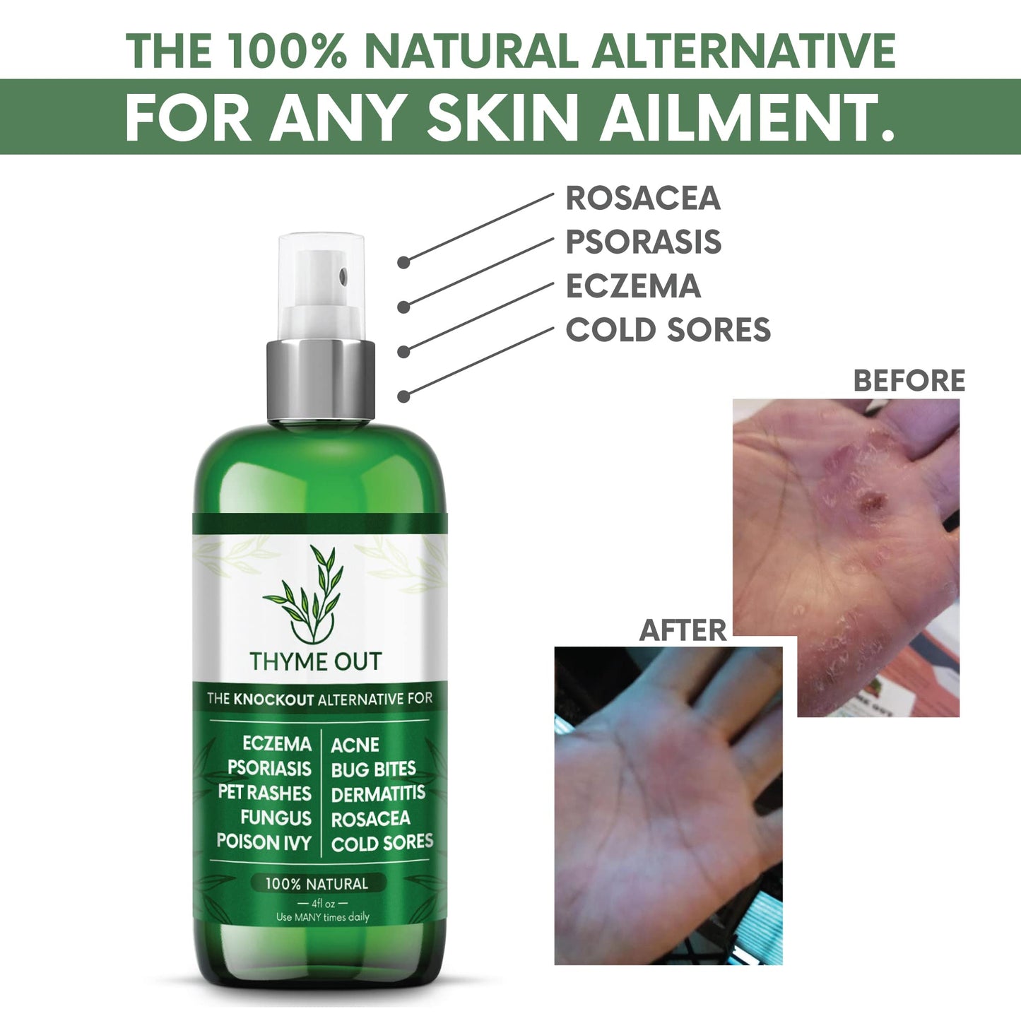 Thyme Out All Natural Eczema Treatment & Anti-Itch Spray | Acne, Psoriasis & More (4oz)