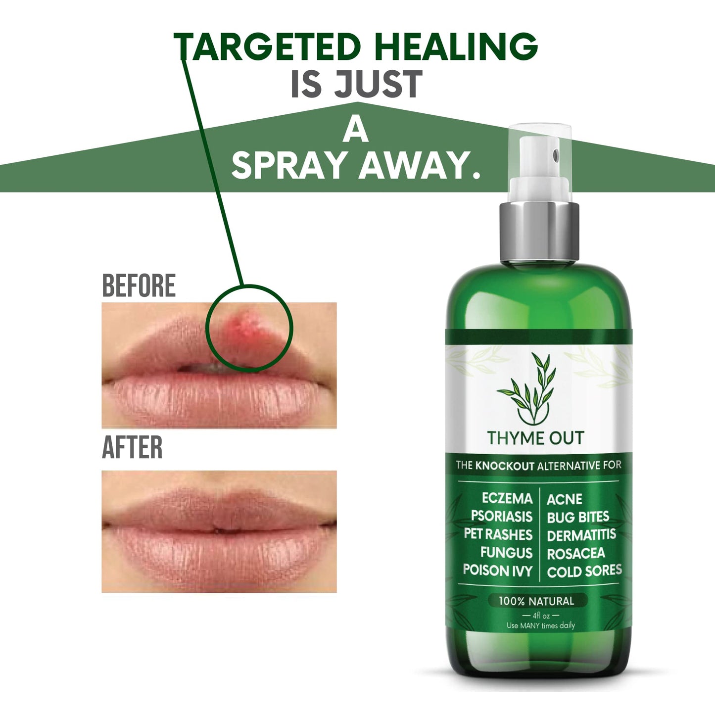 Thyme Out All Natural Eczema Treatment & Anti-Itch Spray | Acne, Psoriasis & More (4oz)