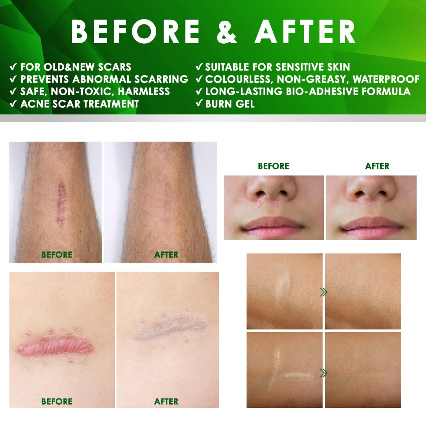 Tobcharm Advanced Keloid Bump Removal Gel | Silicone Scar Treatment for Piercing, Surgery, Acne, Burns | 30g