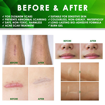 Tobcharm Advanced Keloid Bump Removal Gel | Silicone Scar Treatment for Piercing, Surgery, Acne, Burns | 30g