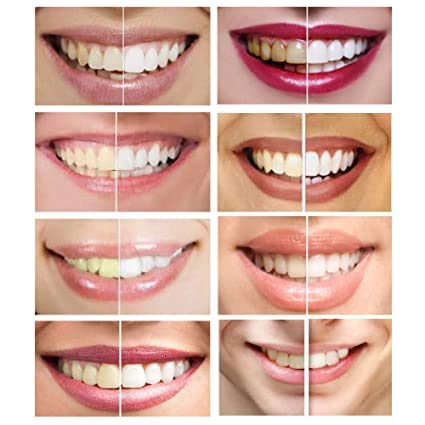 Teeth Whitening Gel Syringe Dispensers 44% Carbamide Peroxide – 10 ml & 5 ml, Mouth Trays Included