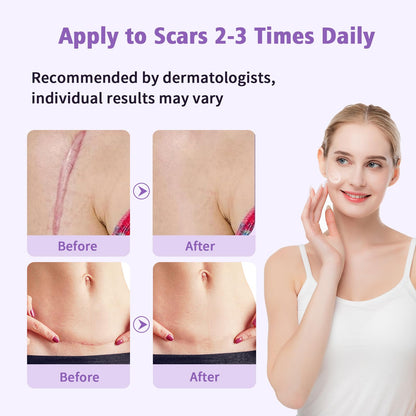 Yarster Silicone Scar Gel - Fade Scars & Stretch Marks, 1.7 oz