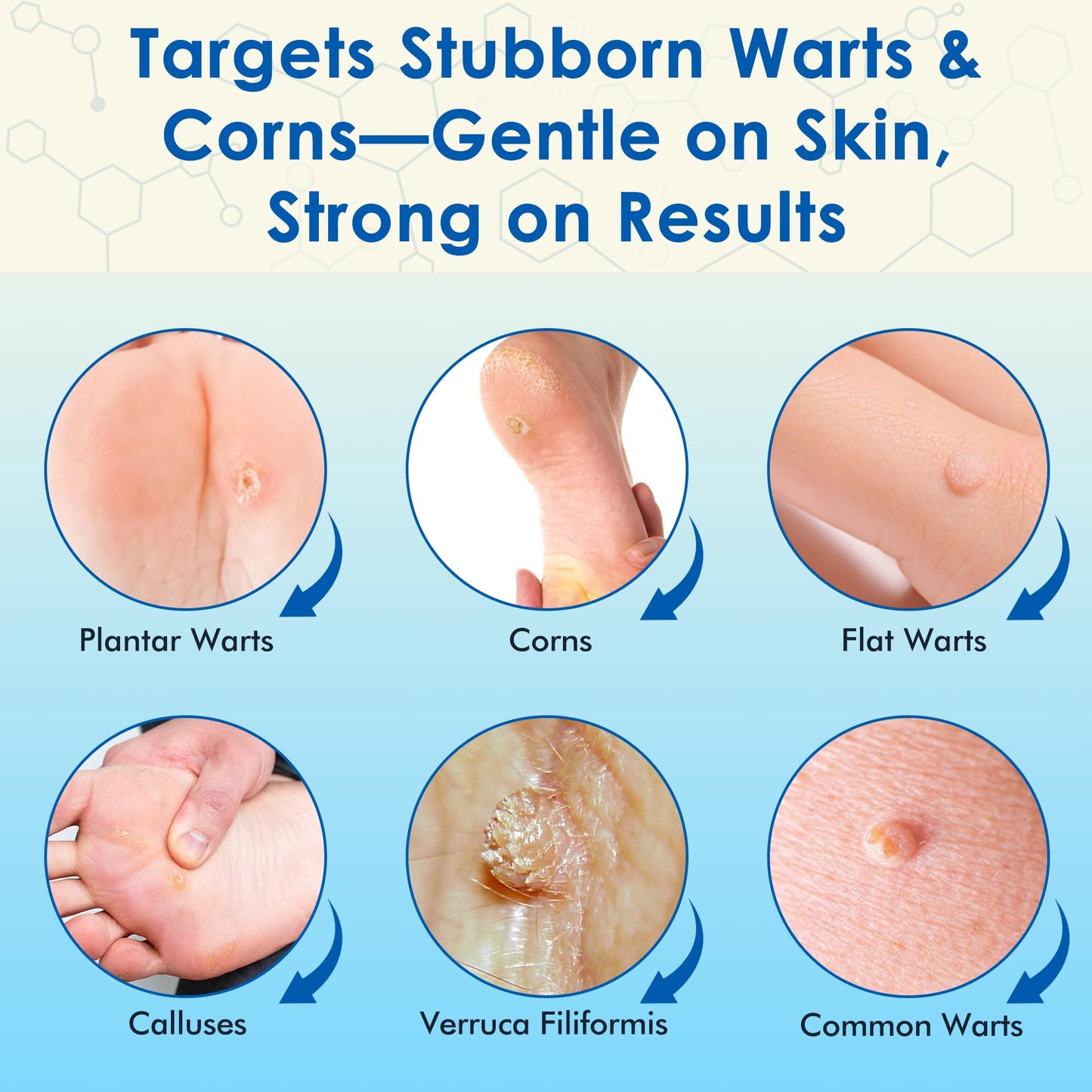 ZGjoib TAG Wart Remover Freeze Off Liquid 17% Salicylic Acid – 1oz Wart Treatment