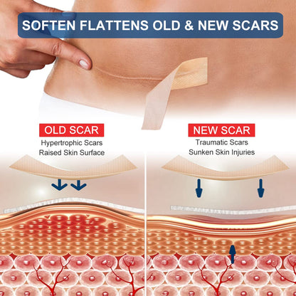 ZODENIS Silicone Scar Sheets – 1.6” x 120” Roll (3M) for Scar Care